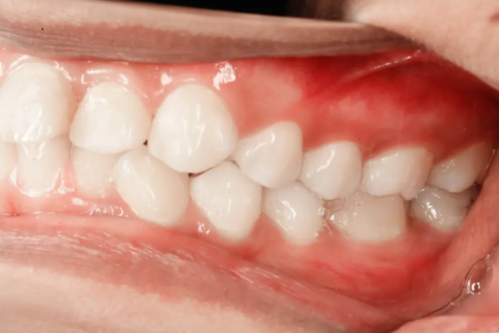 Why Are My Gums Growing Over My Braces? - Video Guide